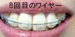 140427虫歯2.JPG